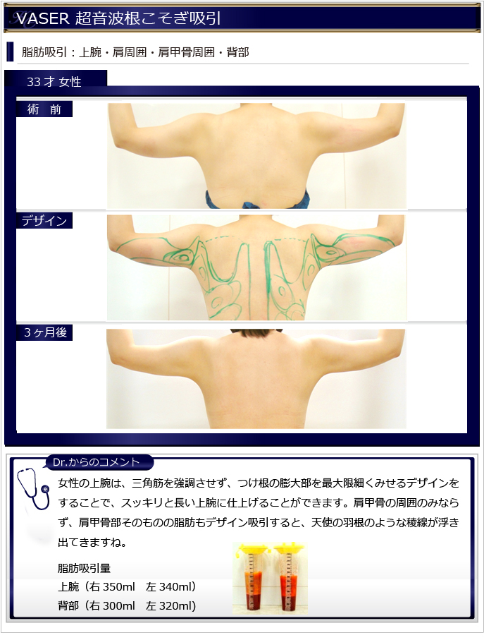 女性脂肪吸引 上腕 二の腕 背部 美容整形 Kunoクリニック