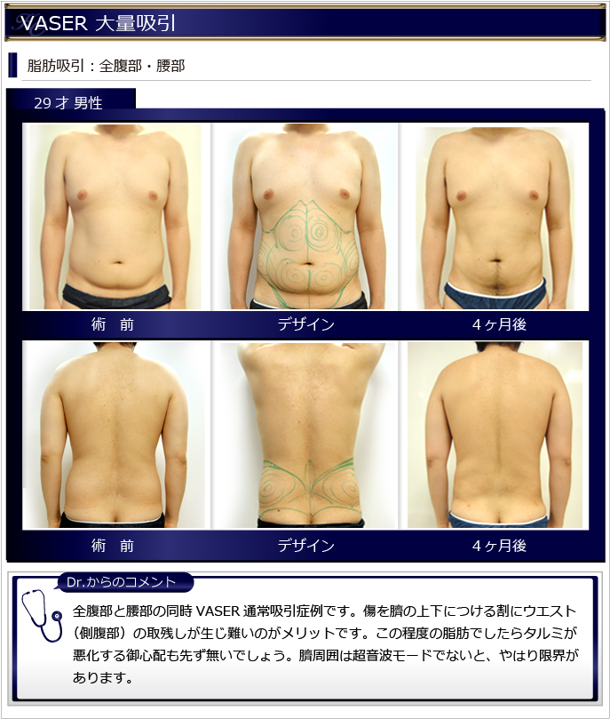 男性脂肪吸引症例 Vaser脂肪吸引美容外科kunoクリニック 大阪 東京