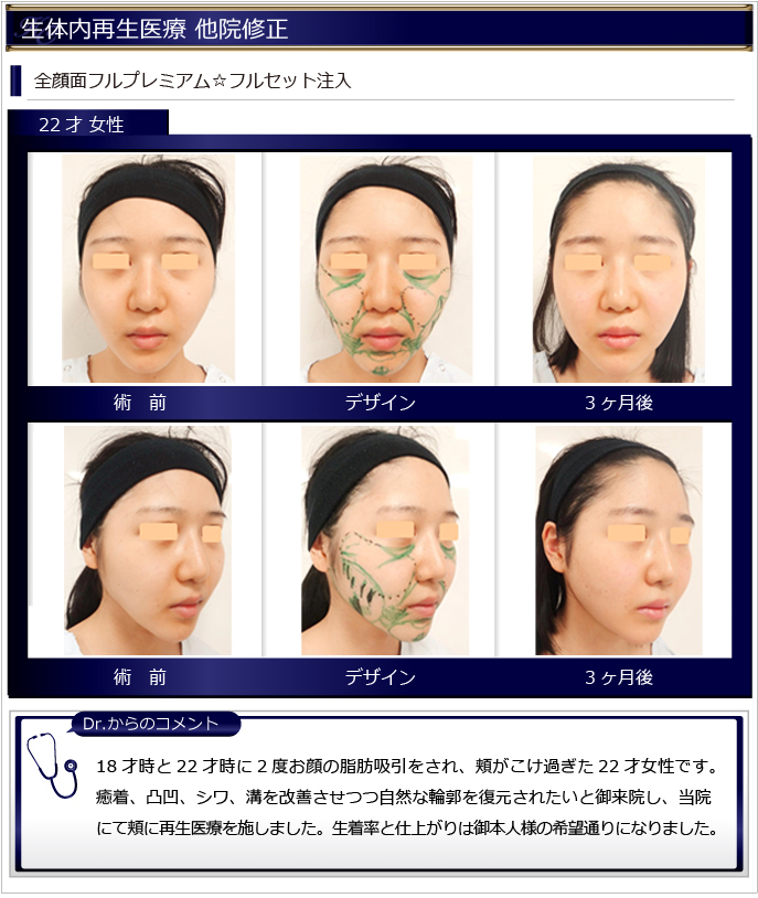 他院による脂肪吸引の失敗を、当院で修正した症例をご紹介|美容整形・美容外科のKunoクリニック(東京麻布院・大阪梅田院)