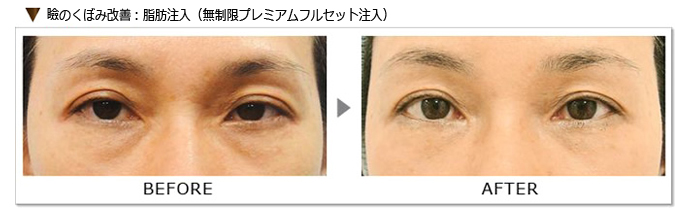瞼のくぼみ改善

